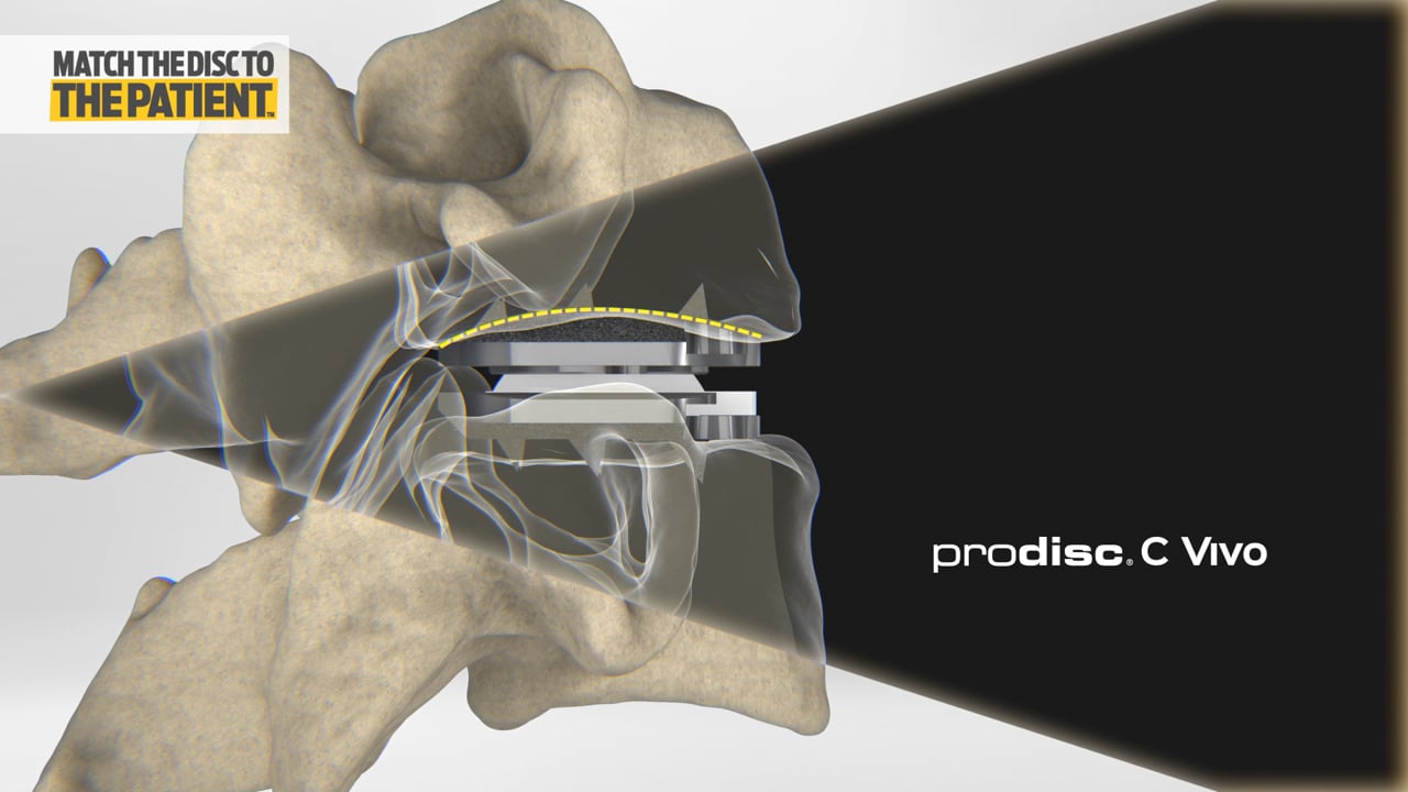 prodisc C cervical artificial disc implants