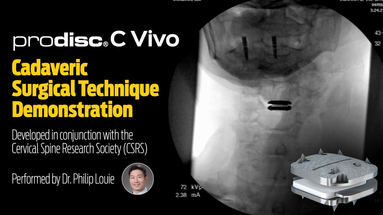 Still frame from the prodisc C Vivo cervical disc replacement animation